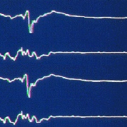 Fichier:Electroencephalogramme.jpg