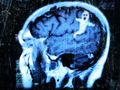 Radiografía de Ann Onima, caso de posesión, 1998. Un Fantasma se alojó en su cerebro y tuvo que ser removido quirúrgicamente