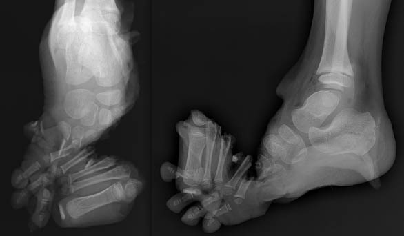 File:Foot x-ray.jpg