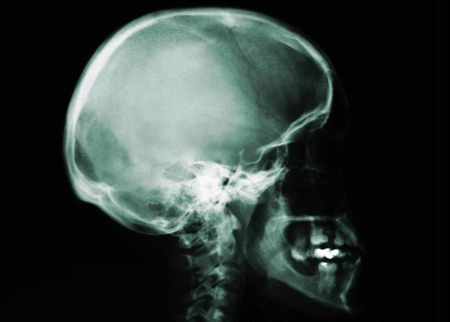 File:Skull x-ray.JPG