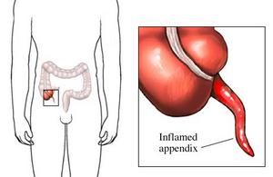 File:Appendix.jpg