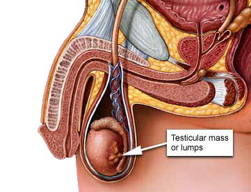 File:Testicular-cancer.jpg