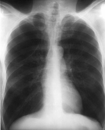 File:Chest x-ray.jpg