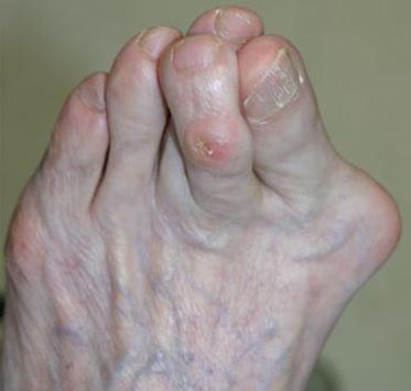 File:Overlapping-toes.jpg