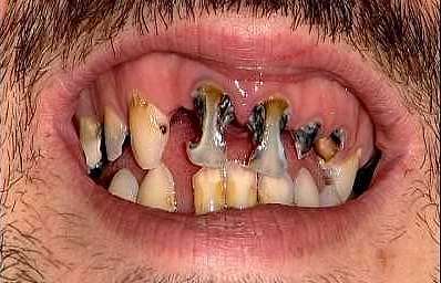 File:Tooth fairy bad teeth.jpg
