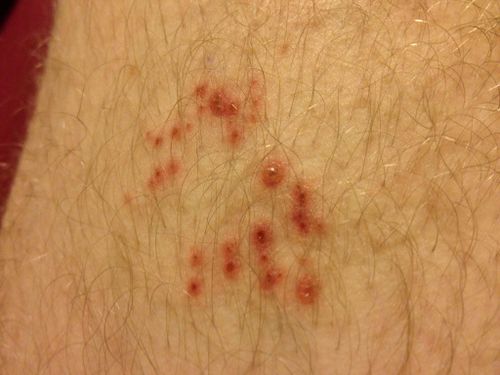 Dating site for genital herpes