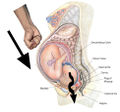Remove baby by punching downward on belly.