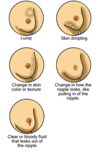 Guide to mammogram complications