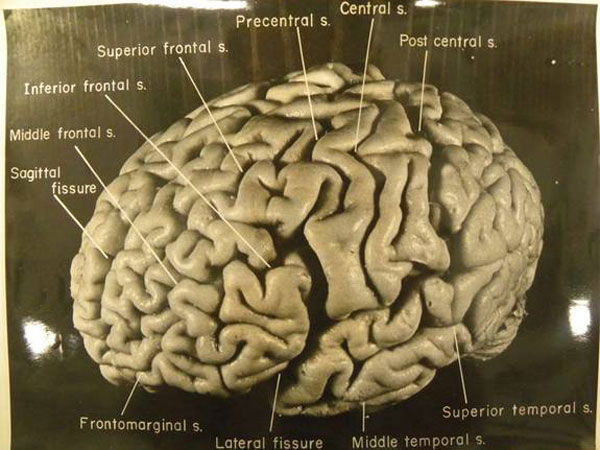 Archivo:Cerebro Einstein.jpg