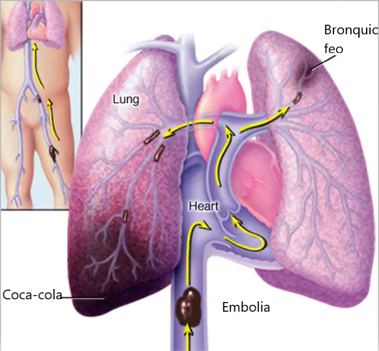 Archivo:Embolia pulmonar.png