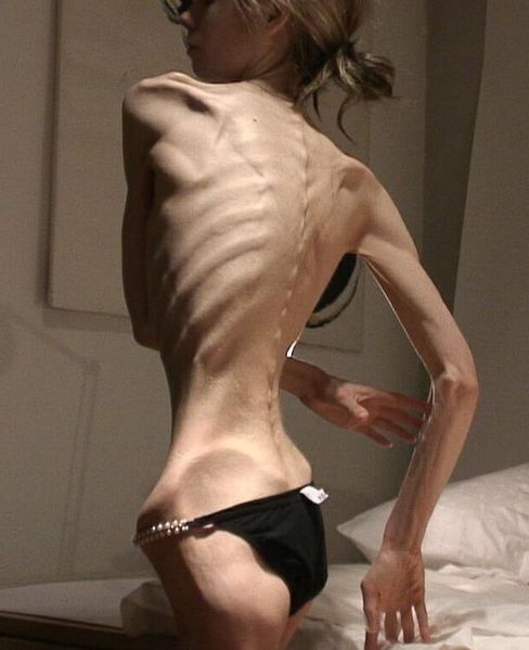 Soubor:Anorexia-cuando-2.jpg