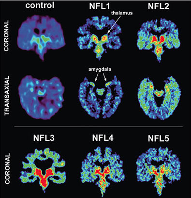 PET-Scan-CTE-400px.jpg