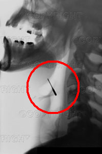 File:Ring stuck in throat.png