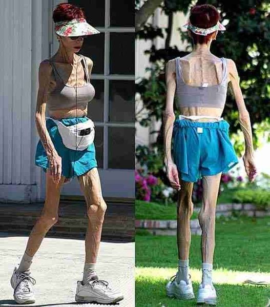 File:Anorexia.jpg