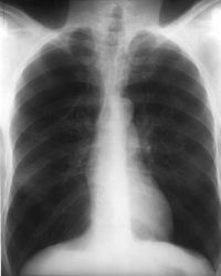 Chest x-ray.jpg