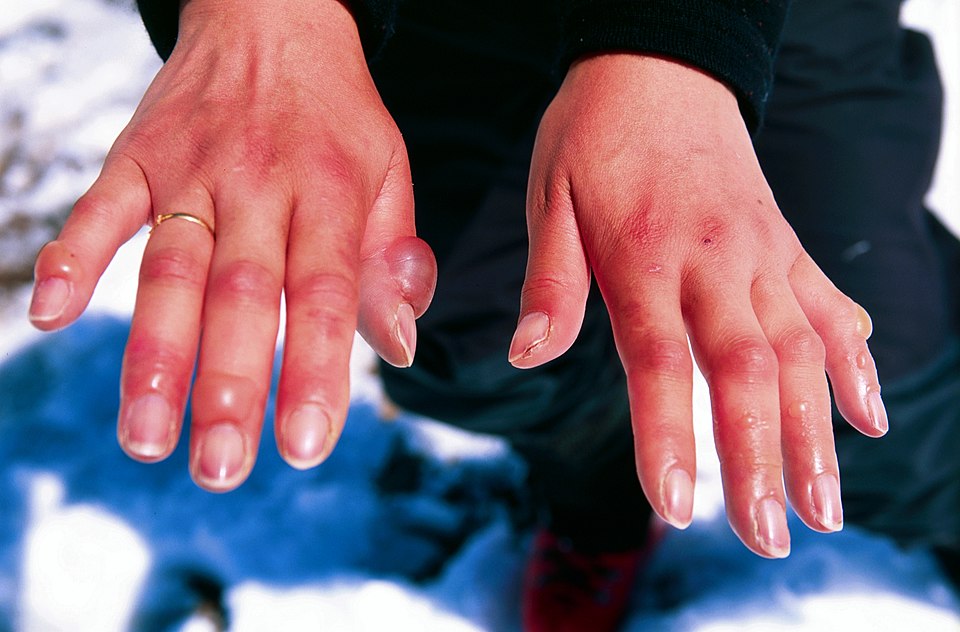 File:Frostbitten hands.jpg